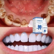 [HCM]Tinh Chất Tẩy Trắng Răng Làm Sạch Răng Miệng Khử Mùi Hôi Miệng Oral Teeth Whitening Essence LANBENA 15ml thumbnail