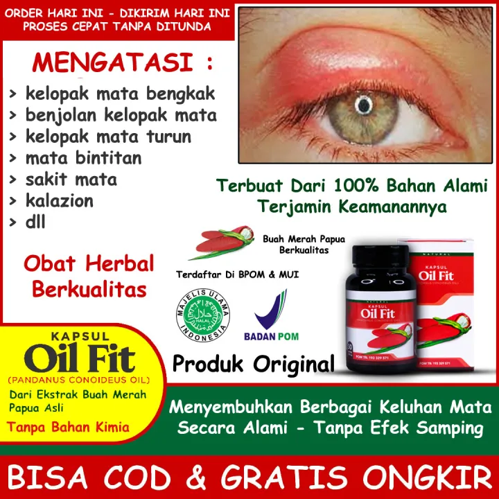 Obat Kelopak Mata Bengkak Bintitan Kalazion Benjolan Di Kelopak Mata ...