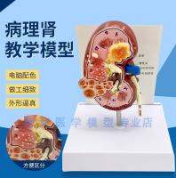 Pathological changes of renal pathological renal kidney model model body dirty anatomize urology medical dirty kidney pathology