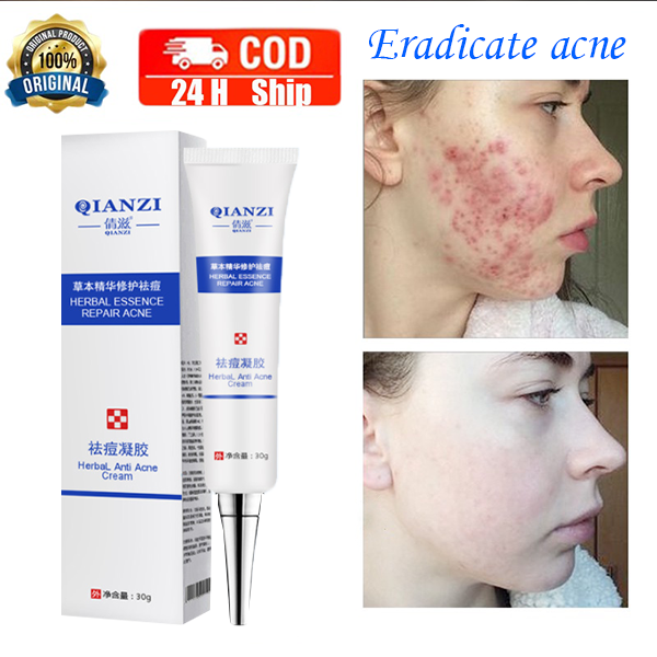 Repair Acne Cream Acne Pit Acne Scar Removal Facial Treatment Acne