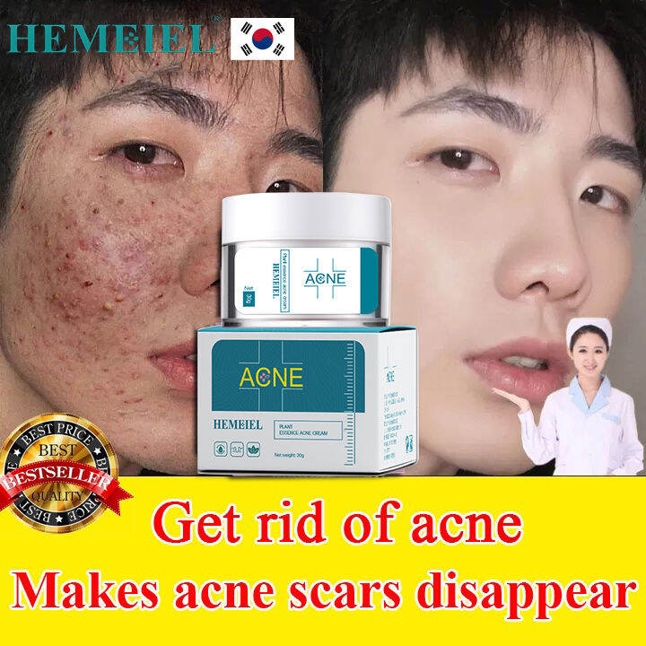 HEMEIEL Acne Scar Remover/Acne Scars Remover For Face/Anti Acne And