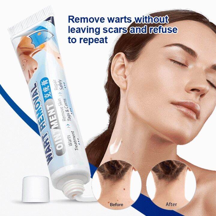Warts Remover Original Cream Effectively Removes and Heals Common Warts