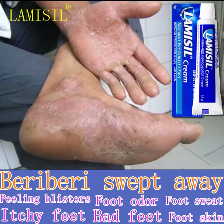 Beriberi buster LAMISIL Athlete's foot cream Itchy feet, peeling feet
