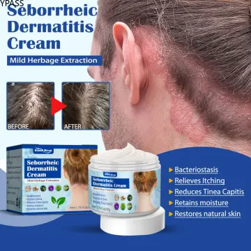 folliculitis scalp