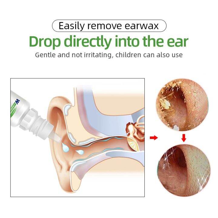 cw-10ml-ear-sodium-bicarbonate-earwax-cleaner-acute-and-chronic-otitis-tinnitus-deafness-sore