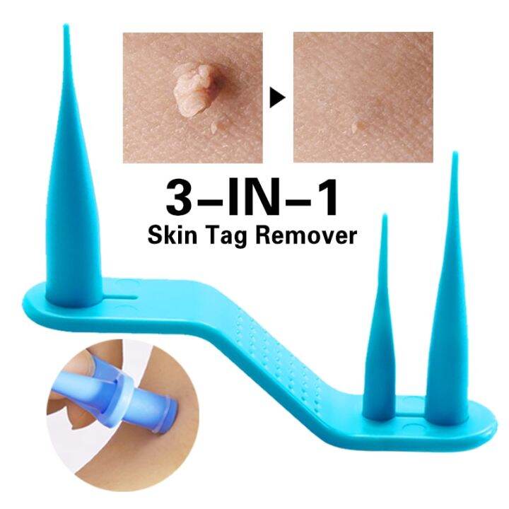 40bands/box 3 In 1 Auto Skin Tag Remover Warts Mole Skin Tag Removal