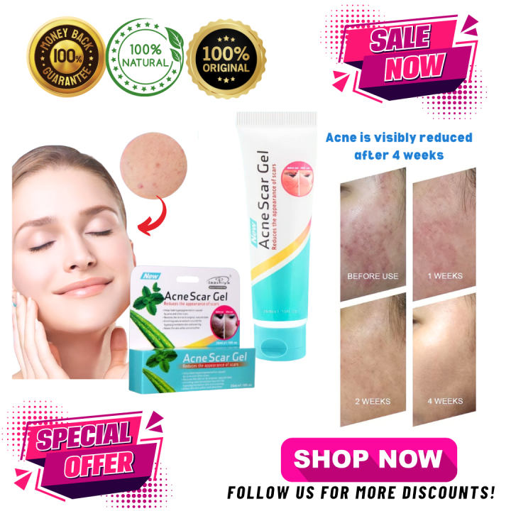 Lighten Acne Marks| Moisturizes and Brightens Skin| Natural, Gentle ...