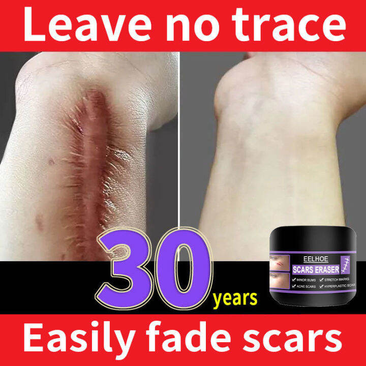 100 Herbal Scar Repair Cream Fast treatment of all scars Scar Fades