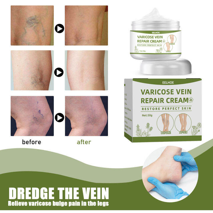 Eelhoe Vein Massage Varicose Vein Cream Soothe Veins and Smoothes Worm