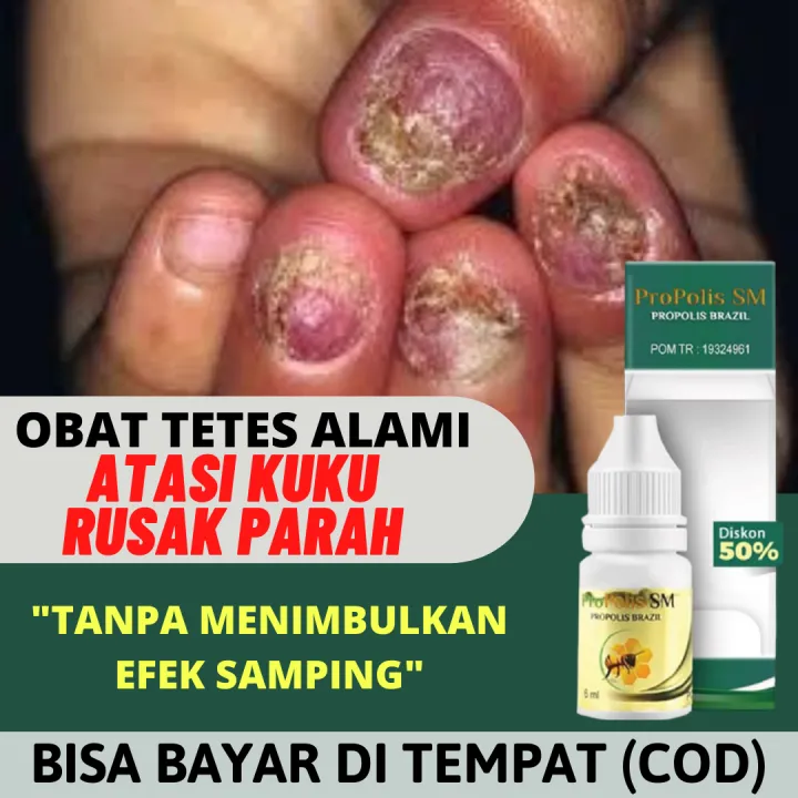Obat Tetes Ps asis Kuku Berjamur Obat Infeksi Kuku Rusak Parah Akibat