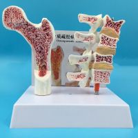 2 parts PVC Human Anatomical Model Osteoporosis Femur Leg Bone Spinal Section Specimen Diseased Lumbar Spine