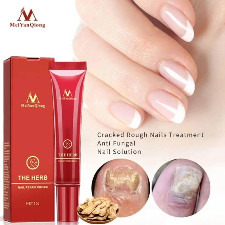 MEIYANQIONG Nail Care Herbal Nail Repair Cream Anti Fungal Nail Chinese  Herbal Toe Nail Fungus Treatment | Lazada PH