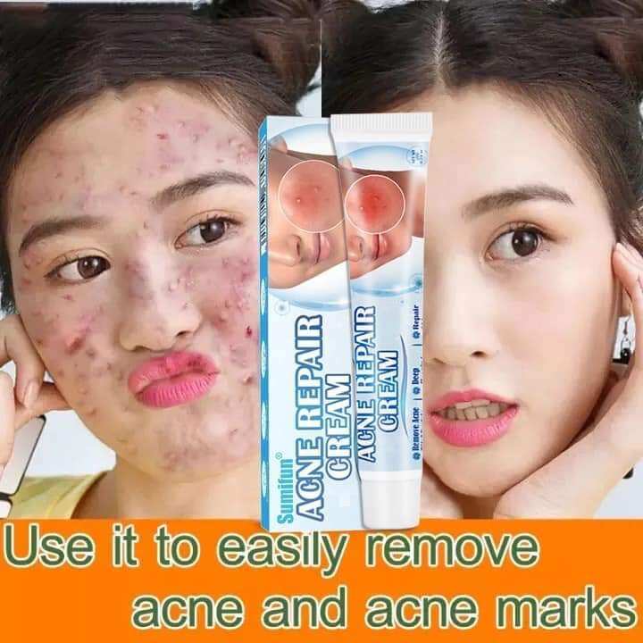 100 Effective! 20g Sumifun Chinese Medicine Acne Treatment Remove