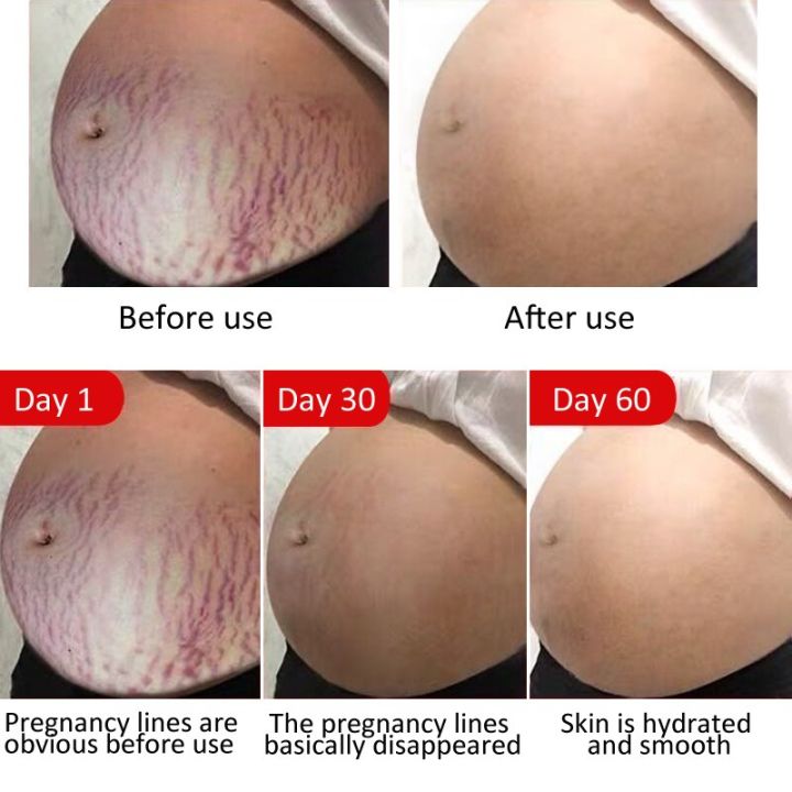 บำรุงผิวกายลบรอยแผลเป็นจากการตั้งครรภ์ลบออก-krim-stretch-mark-ป้องกันการริ้วรอยต่อต้านริ้วรอยผิวคลอด