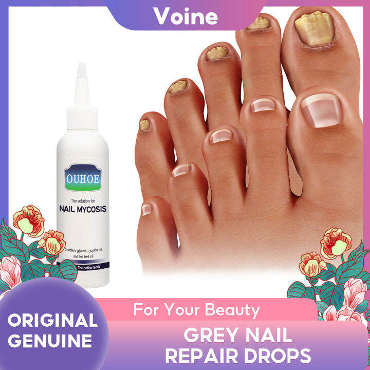 Ouhoe Grey Nail Repair Drops For Hand And Foot Grey Nail Repair Soft Nail Brightening And