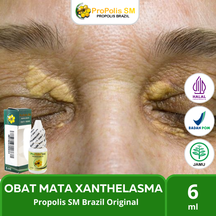 Propolis Asli Original - Obat Xanthelasma Penghilang Gumpalan Lemak Di ...