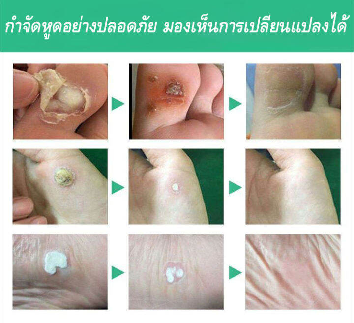 wart-removal-liquid-เอสเซ้นลอกหูด-10ml-ยาแต้มหูด-ลอกหูดตาปลา-ปลอดภัยไม่เจ็บตัว-ขจัดติ่งเนื้อ-เอสเซ้นลอกหูด-ไม่ทิ้งร่องรอยป-ครีมกําจัดไฝหูดติ่งเนื้อ