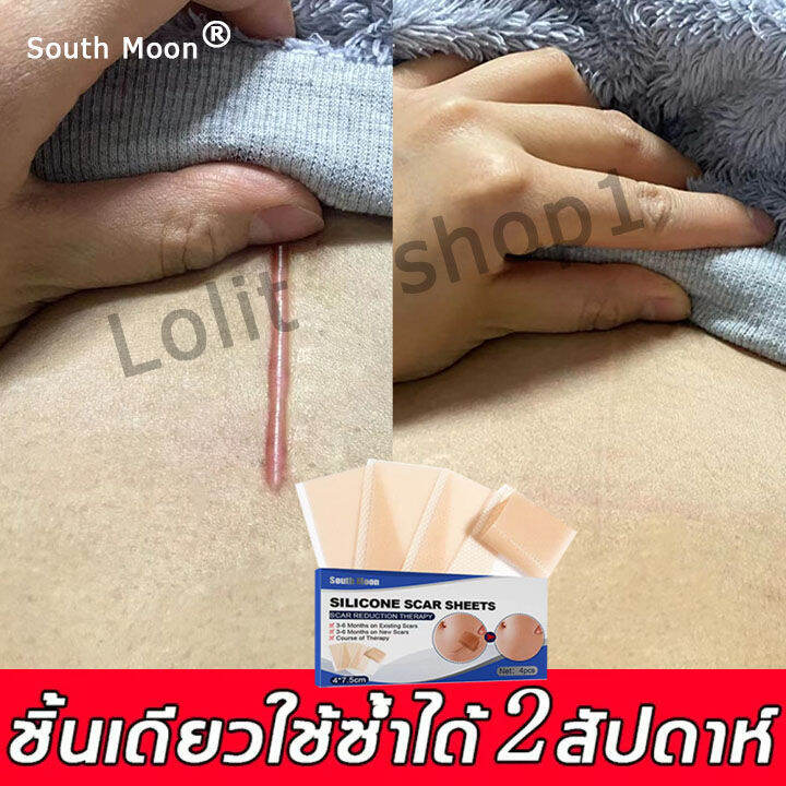 South Moon แผ่นแปะแผลเป็น ครีมทาแผลเป็น รักษาแผลเป็น ตัดตามต้องการ สามารถปรับปรุงรอยแตกลาย ลดรอย