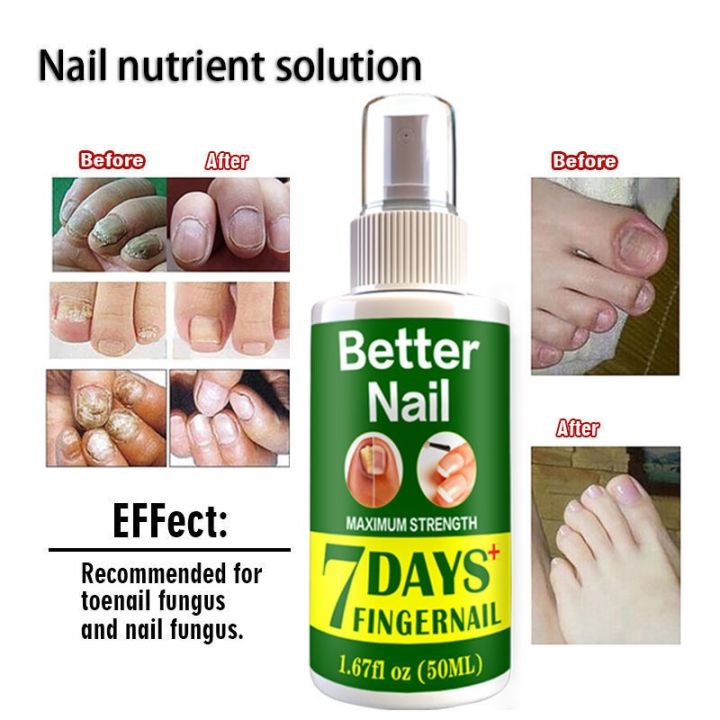 fungal-nail-repair-spray-nursing-treatment-foot-nail-fungus-removal-gel-anti-infective-paronychia-onychomycosis-care