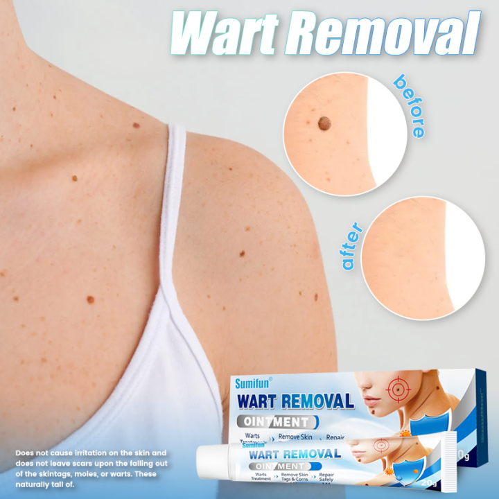 Warts Remover Original Watson Warts Removal Skin Tags And Warts Remover Original Warts Removal