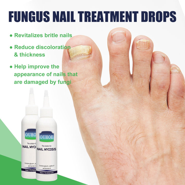 ouhoe-เจลกำจัดเชื้อราเล็บเท้าการรักษาเล็บเชื้อราแบบเหลวป้องกันการติดเชื้อ-onychomycosis-เท้าเล็บเท้ากำจัดเชื้อราเจลบำรุงผิวซ่อมแซมปัญหาเล็บ-75มล-ถุง