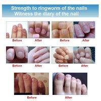 3ml Nail Repair Treatment Essential Oil Cleanser Onychomycosis Remover Serum