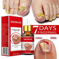 การรักษาเชื้อราเล็บ Feet Care Essence เล็บเท้า Whitening Toe เล็บเจลกำจัดเชื้อรา Anti Infection Paronychia Onychomycosis