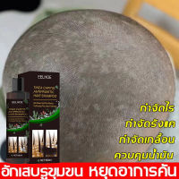 EELHOE 100ml ขจัดรังแค หยุดอาการคัน ควบคุมน้ำมัน (แชมพูขจัดรังแค ขจัดรังแค ยาสระผมเชื้อรา แชมพูสมุนไพรยาสระผม ยาสระผมรังแค แชมพูแก้เชื้อรา แชมพูรักษารังแค ยาสระผมขจัดรังแค ดูแลหนังศีรษะ ยาสระผมแก้เชื้อรา ยาสระผม แชมพูคัน บำรุงรากผม)