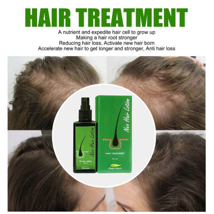 Neo Hair Lotion 100 Natural Treatment Uni Herbs Spray Anti Hair Loss