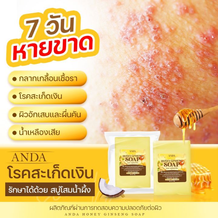 พร้อมส่ง-สบู่โสมน้ำผึ้ง-anda-โรคสะเก็ดเงิน-โรคผิวหนังคับ-กลากเกลื้อน-เชื้อรา-น้ำเหลืองเสีย-จบที่ก้อนเดียว-หายขาด