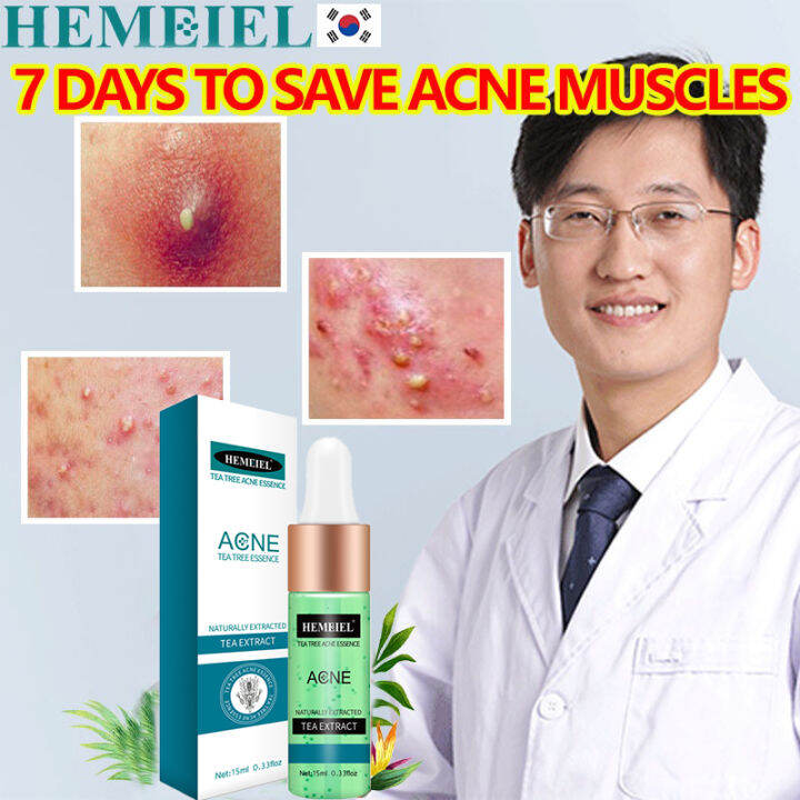 HEMEIEL Anti Acne and Pimples Serum / Pang Tanggal Ng Pimples/ Pimple ...