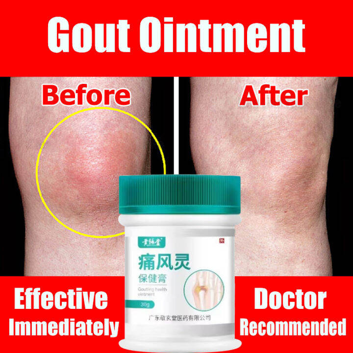 Gout Ointment Cream For Arthritis Treatment Gout Cause Joint Knee Pain