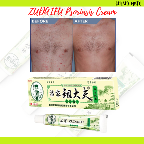 ORIGINAL 15g zudaifu Chinese Herbal Skin Psoriasis Cream Dermatitis ...