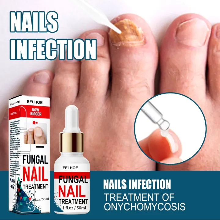 EELHOE Fungal Nail Treatment Finger Toe Care Nail Fungus Liquid Nail