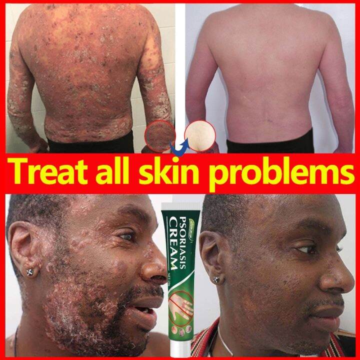 Psoriasis Herbal Cream Antibacterial Anti itch Relief Dermatitis Eczema