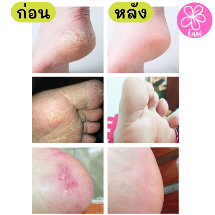 ซื้อครีม-แถมฟรี-ชุดขูดส้นเท้าแตกด้ามไม้-ครีมบำรุงส้นเท้าแตก-ครีมบำรุงเท้า-ครีมทาเท้า-ครีมทาส้นเท้า-ที่ขัดส้นแตก