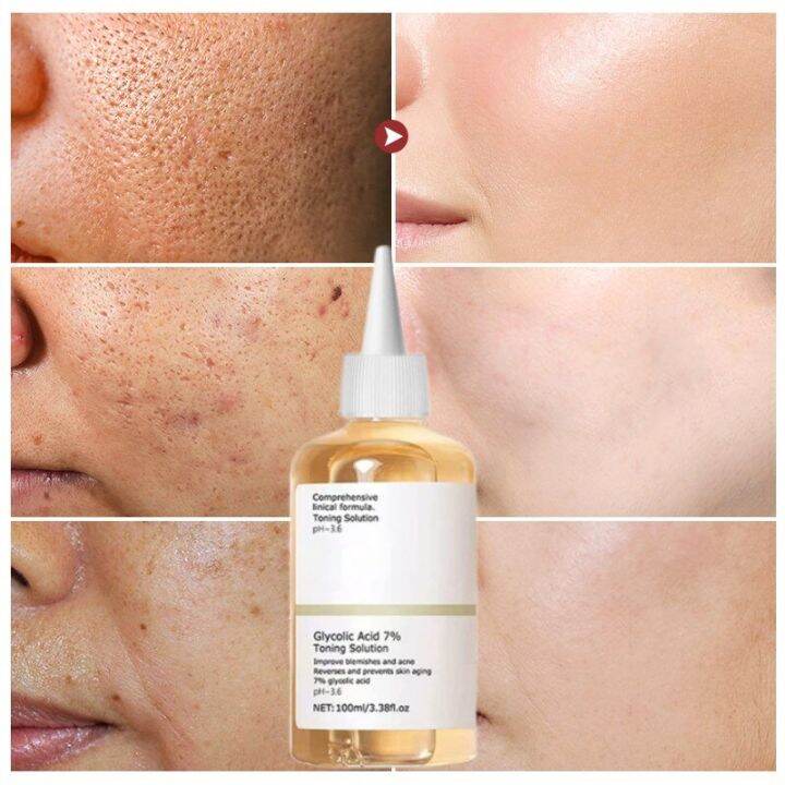 Glycolic Acid 7 Acne Removal Serum Effective Acne Treatment Repair