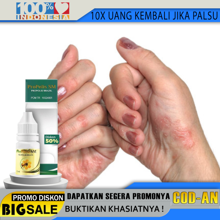 Obat Tetesoles Gatal Berair Di Jari Tangan Dan Kaki Obat Bintik Bintik Berair Obat Oles Kulit 4122