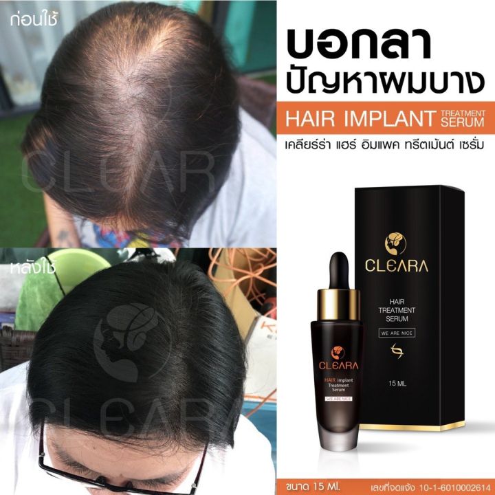 ส่งฟรี-cleara-สเปร์บำรุงรากผม-1-ขวด-บอกลาหัวล้าน-ผมบาง-ผมหนาขึ้น-บำรุงเส้นผม-รากผมแข็งแรงขึ้น-ลดการหลุดร่วง-50ml-เคลียร์ร่า