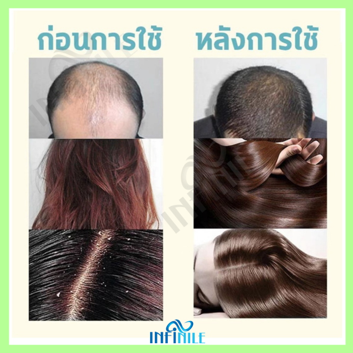 แชมพูแก้ผมร่วง-แชมพูขิง-ขิงช่วยป้องกันผมร่วง-แชมพูสำหรับป้องกันผมขาดหลุดร่วงพร้อมบำรุงผม-ขิงบำรุงลึกถึงราก-ปลูกผมให้สวยเงางาม