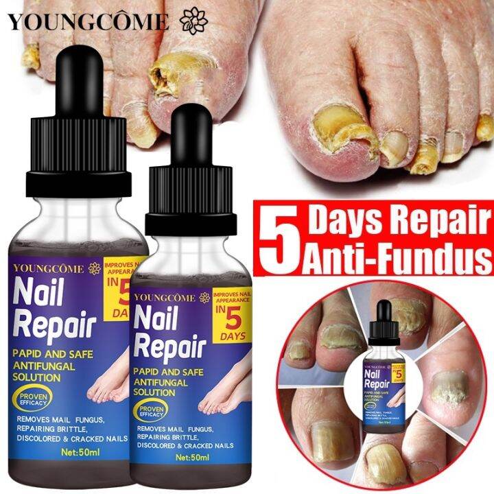 Nail Fungal Treatment Essence Effective Fungus Serum Nail