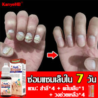 ?พร้อมส่ง? KanyeHB ยาฆ่าเชื้อราเล็บมือ เชื้อราเล็บมือ น้ำยาซ่อมแซมเล็บ ยาทาแก้เชื้อราที่เล็บ รักษาเล็บเสีย เซรั่มบำรุงเล็บ เซรั่มรักษาเล็บ ยารักษาเชื้อราที่เล็บ น้ำมันบำรุงเล็บ เอ็สเซ้น ซ่อมแซมเล็บเสีย รักษาโรคเชื้อราที่เล็บ น้ำยากันเชือราเล็บ