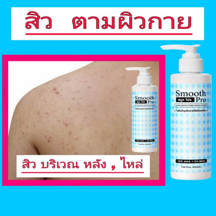 smooth-pro-โลชั่นรักษา-ขนคุด-สิวตามผิวกาย-ผิวหยาบกร้าน-ไม่เรียบเนียน