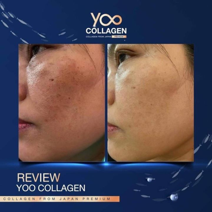 โปรสมาชิก-ยูคอลลาเจนแท้-คอลลาเจนผิวขาว-คอลลาเจนกระดูก-yoo-collagen-แบบชง-บำรุงข้อเข่า-ข้อต่อ-ข้อกระดูก-ลดฝ้า-กระ-ผิวพรรณ-nnn