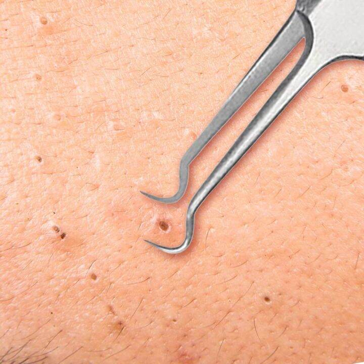 trim-that-presses-acne-ที่กดสิวกดสิว-ไม้กดสิว-ที่กดสิวแบบหมอ-ที่กดสิวสแตนเลส-ไม้กดสิวอุดตัน-ไม้กดสิวเสี้ยน-แหนบกดสิว-สแตนเลส-ที่กดสิวอุดตัน