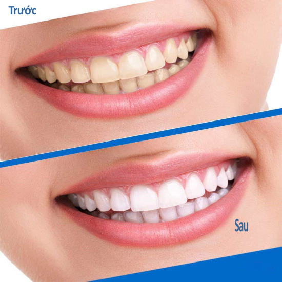 Set 7 miếng dán trắng răng 5d white teeth whitening strips - ảnh sản phẩm 1