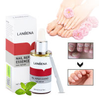 LANBENA เซรั่มรักษาเชื้อราเล็บ,เจลกำจัดเล็บเชื้อราป้องกันการติดต่อการใช้สารสกัดจากปาร์เจีย