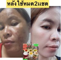 ครีมคุณนาย หน้าขาวใสไร้สิวฝ้ากระจุดด่างดำ3กระปุกขนาด10กรัมเห็นผลตั้งแต่เซตแรก