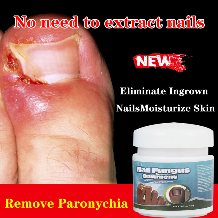 Special ointment for removing soft nails, reducing swelling