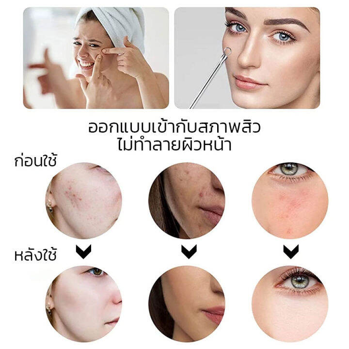 ชุดกดสิว-7-ชิ้น-เครื่องกำจัดสิว-เครื่องกำจัดสิวหัวดำ-ที่กดสิว-สำหรับสิว-เข็มกดสิว-สิว-7pcs-ชิ้น-เซ็ต